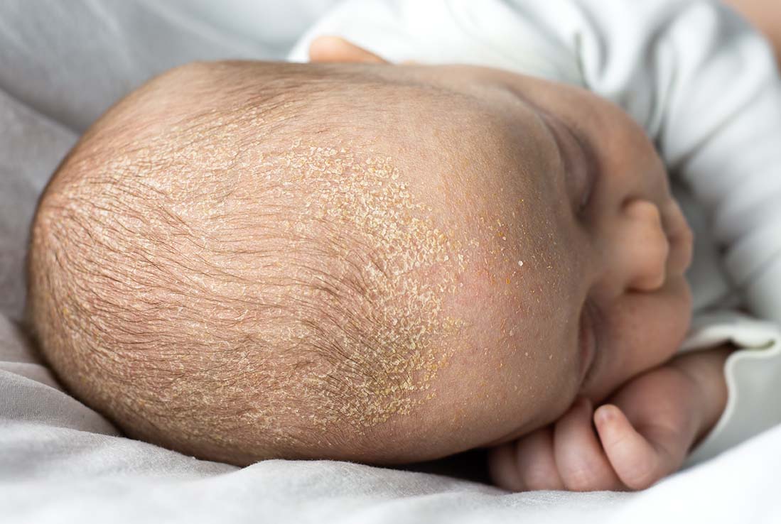 Seborrheic,Dermatitis,Crusts,On,The,Baby's,Head.,Child,With,Seborrhea