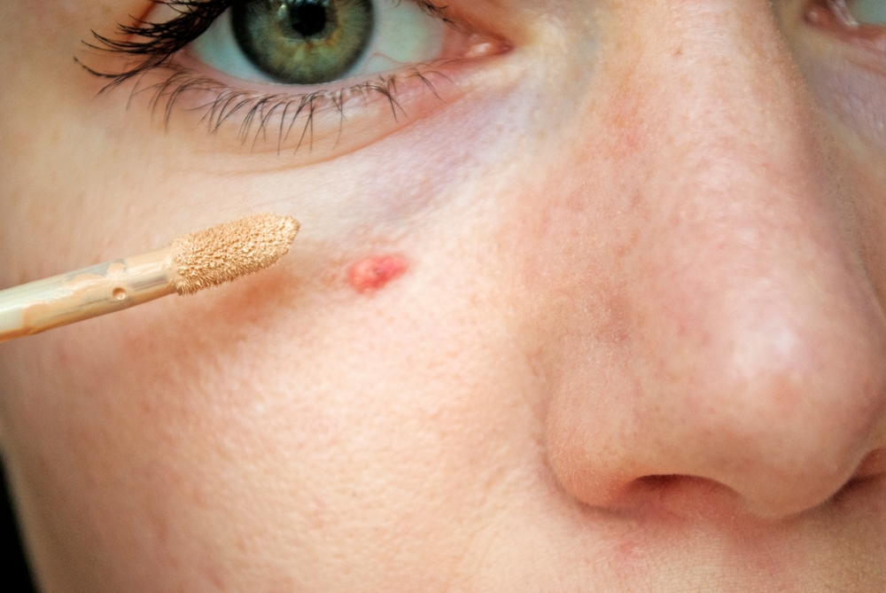 Close-up,Shot,,Covering,Pimple,With,Concealer.,Even,Out,Skin,Tone.