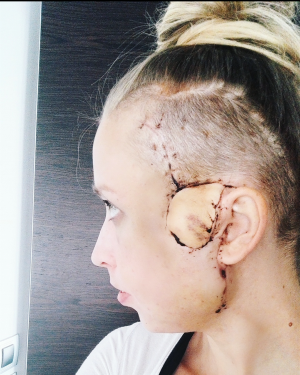 monthaftersurgery