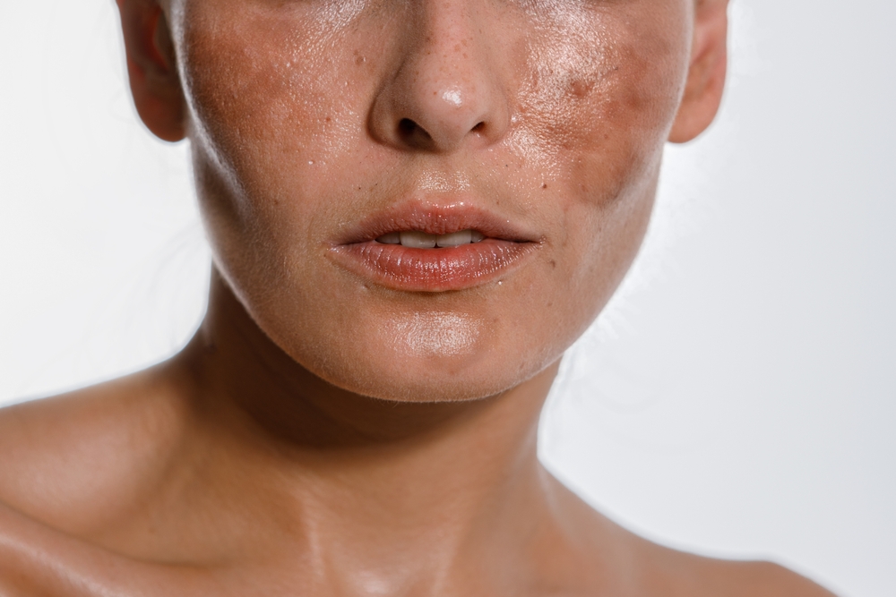 Hyperpigmentation,Of,Female,Skin,,Close-up,Of,A,Part,Of,The