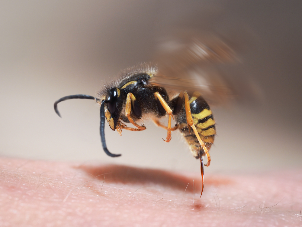 Wasp,Sting,Pulls,Out,Of,Human,Skin.,Macro