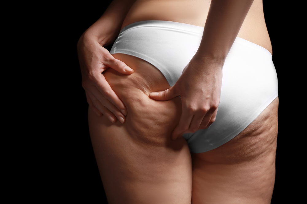 Woman,With,Cellulite,Problem,On,Black,Background